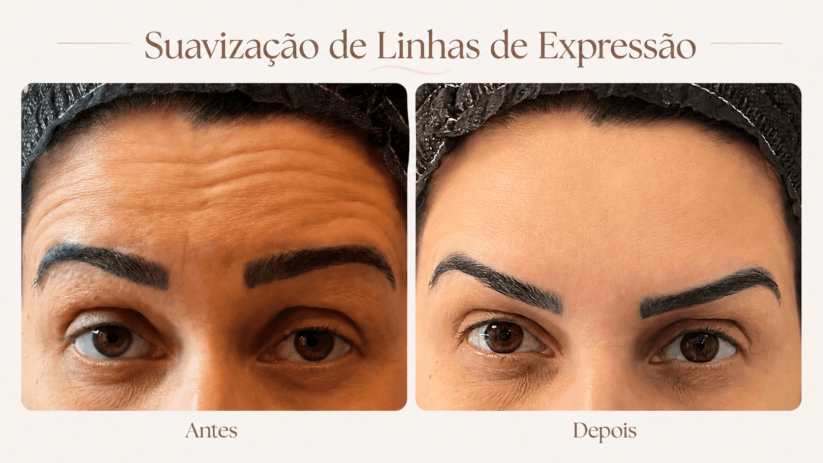 Resultado de tratamento para linhas de expressão antes e depois