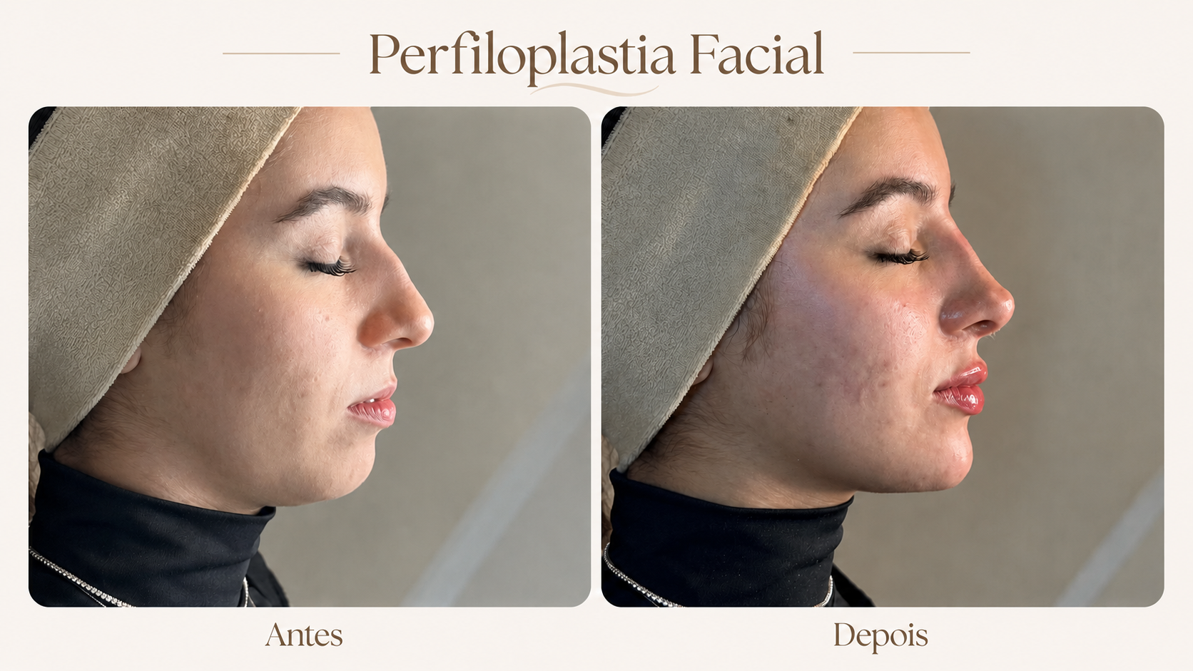 Resultado de perfiloplastia facial