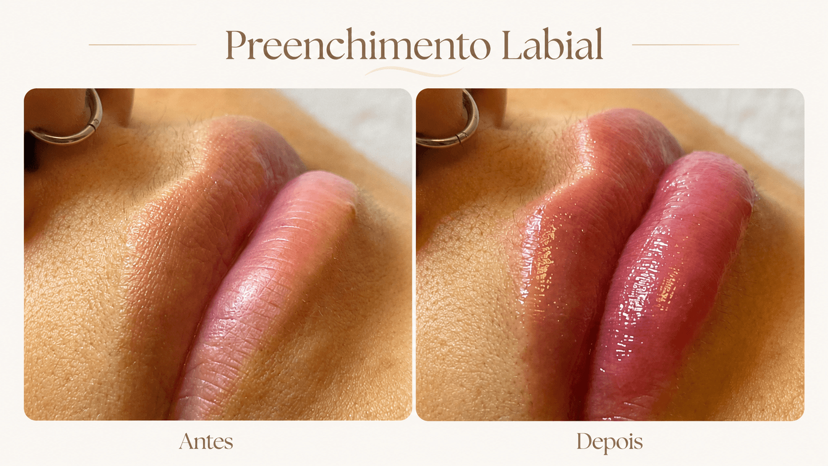 Resultado de preenchimento labial