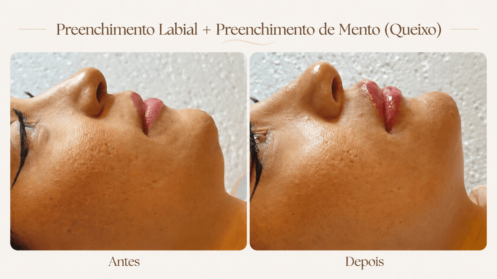 Resultado de preenchimento labial e preenchimento de mento
