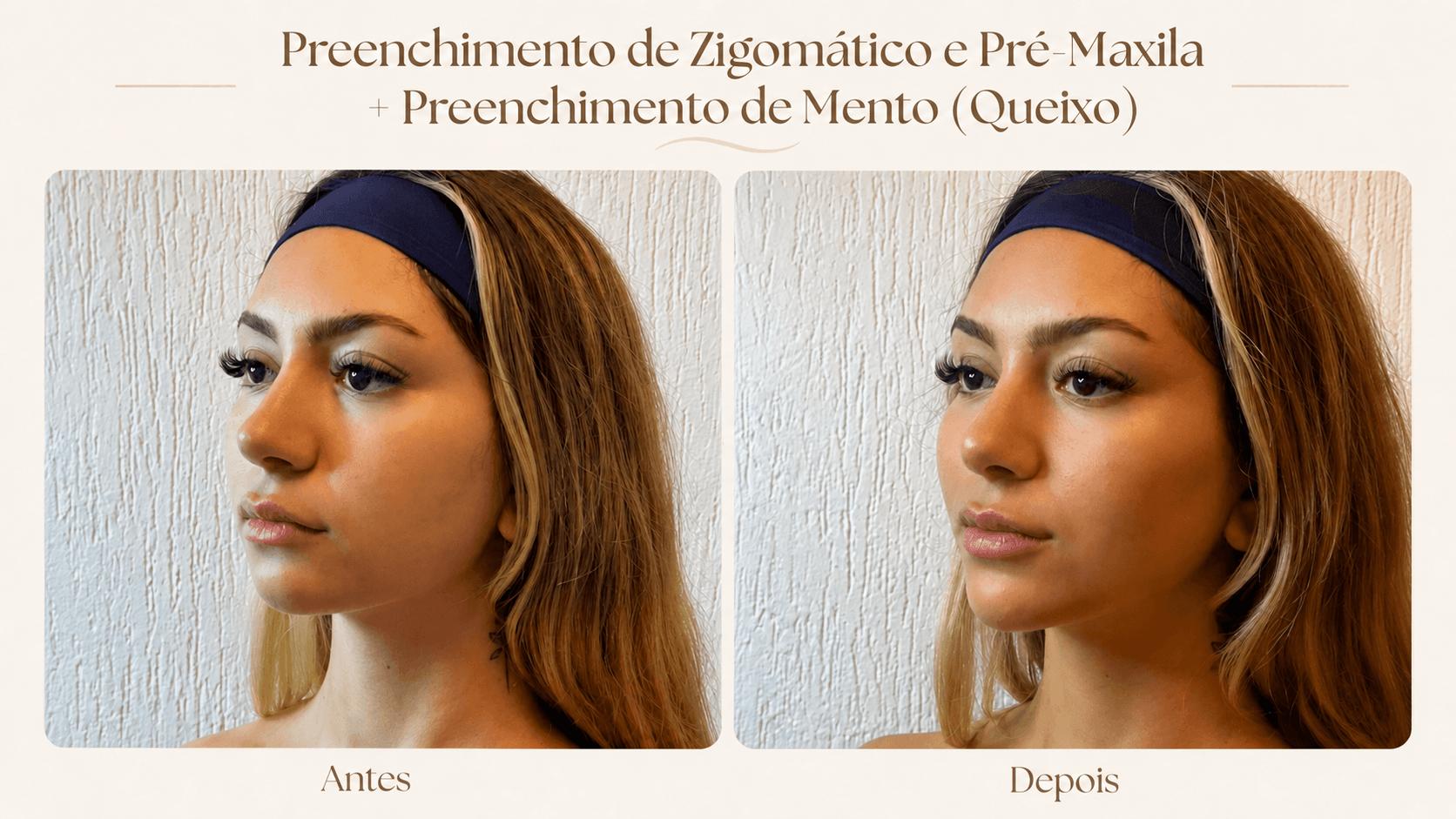 Resultado de preenchimento de zigomático, pré-maxila e mento