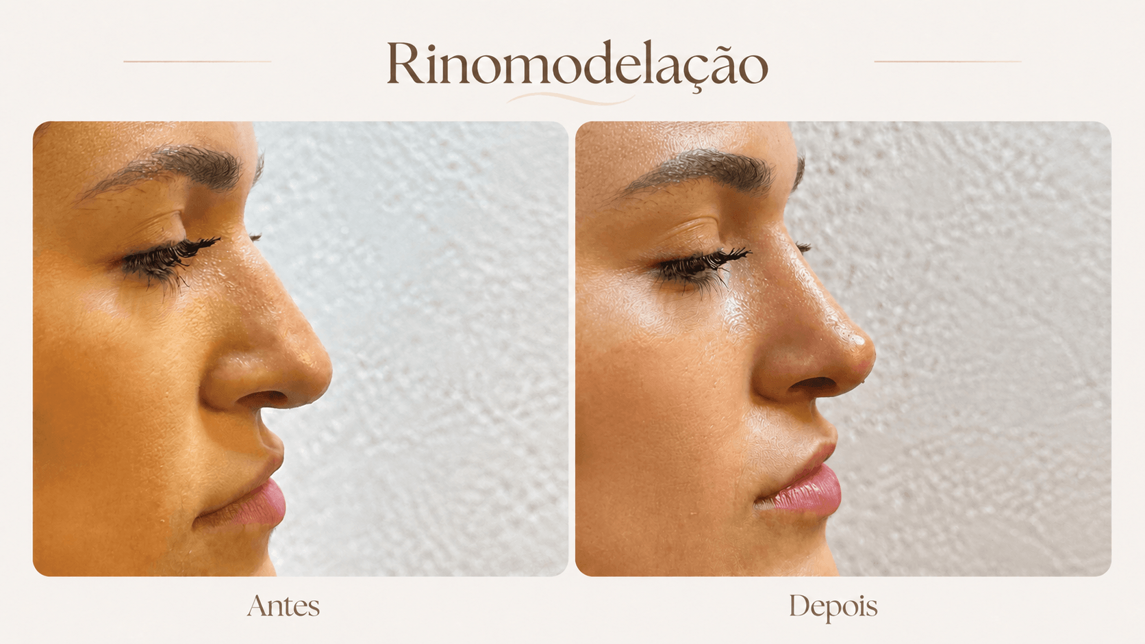 Resultado de rinomodelação antes e depois